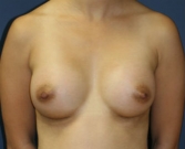 Feel Beautiful - Breast Augment San Diego, Case 60 - After Photo